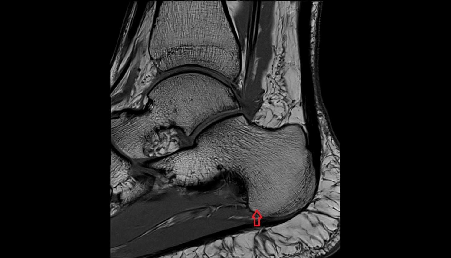 Calcaneal tubercle  mri  anatomy labelled image-img-00000-00000_00001