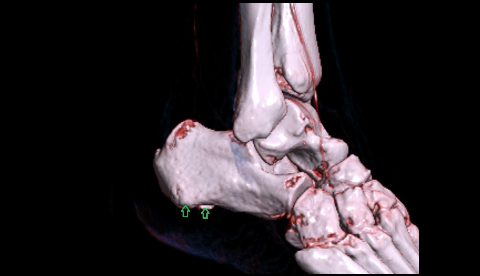 Calcaneal tuberosity 3d