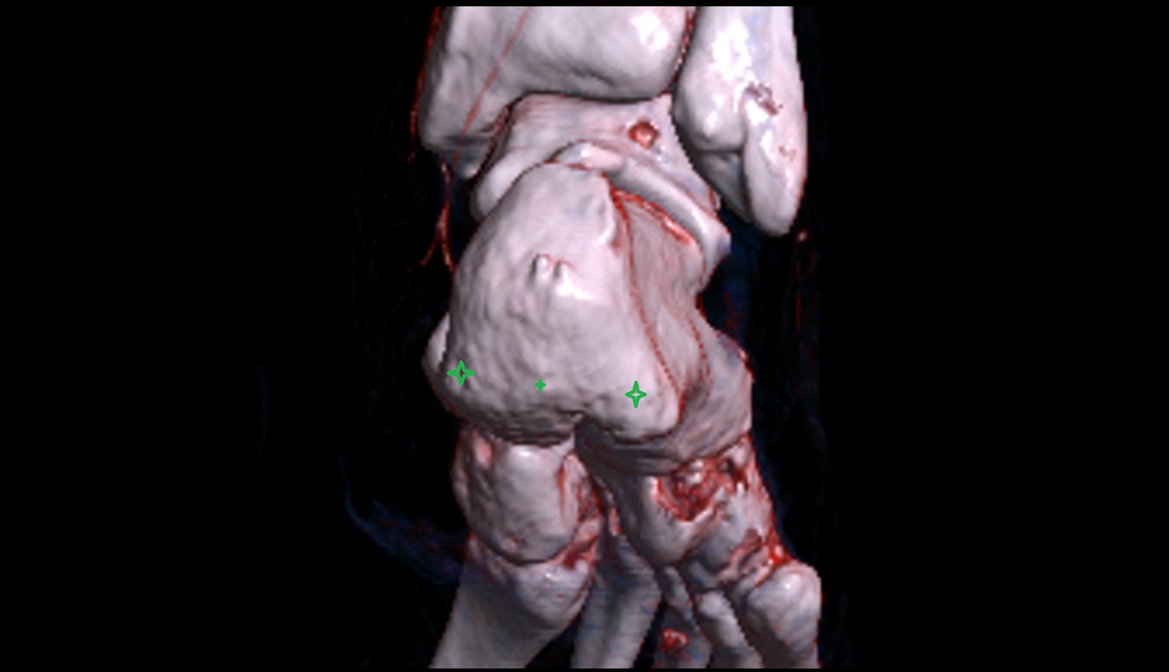 Calcaneal tuberosity 3d1