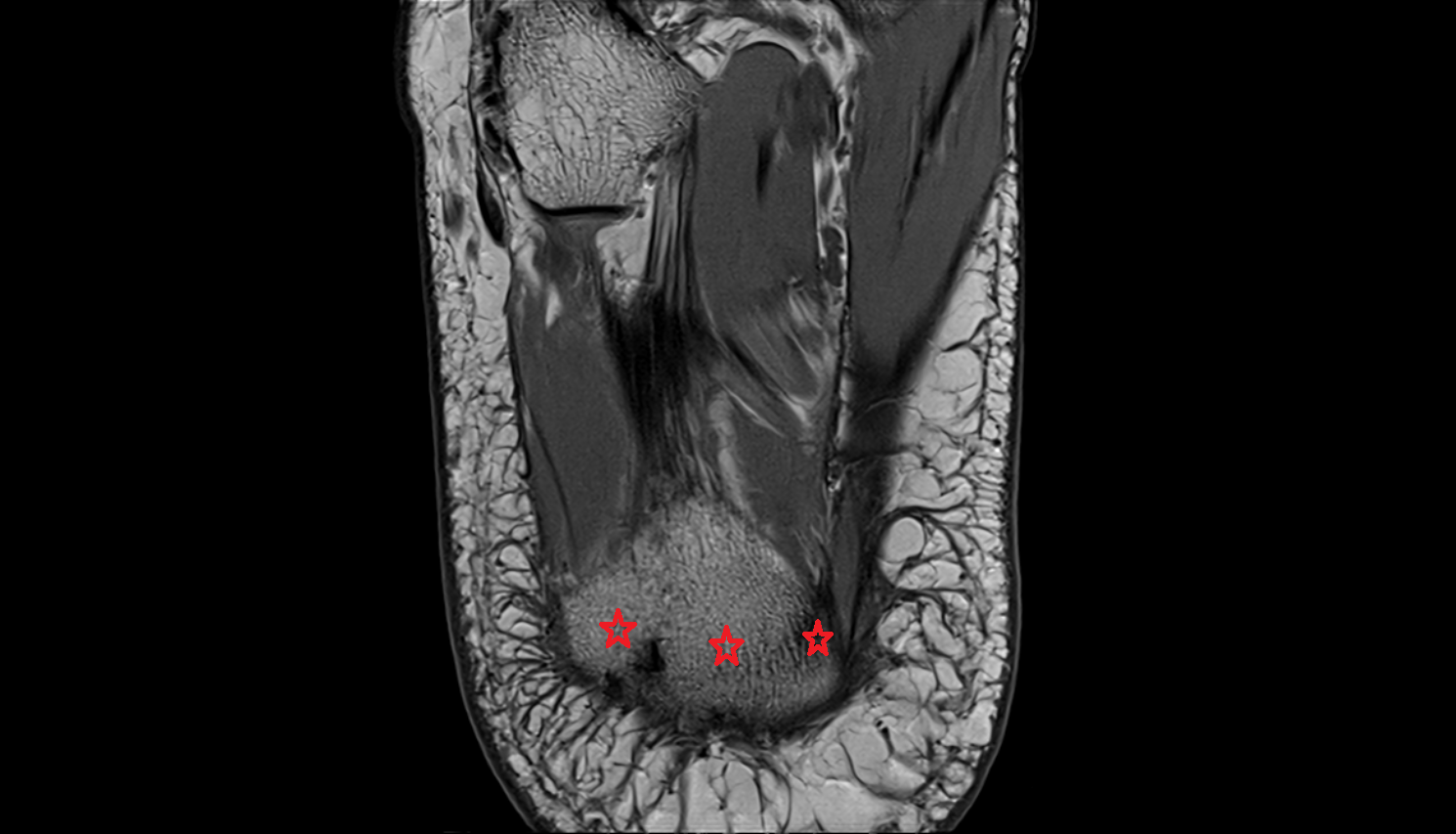 Calcaneal tuberosity  mri  anatomy labelled image-img-00000-00000