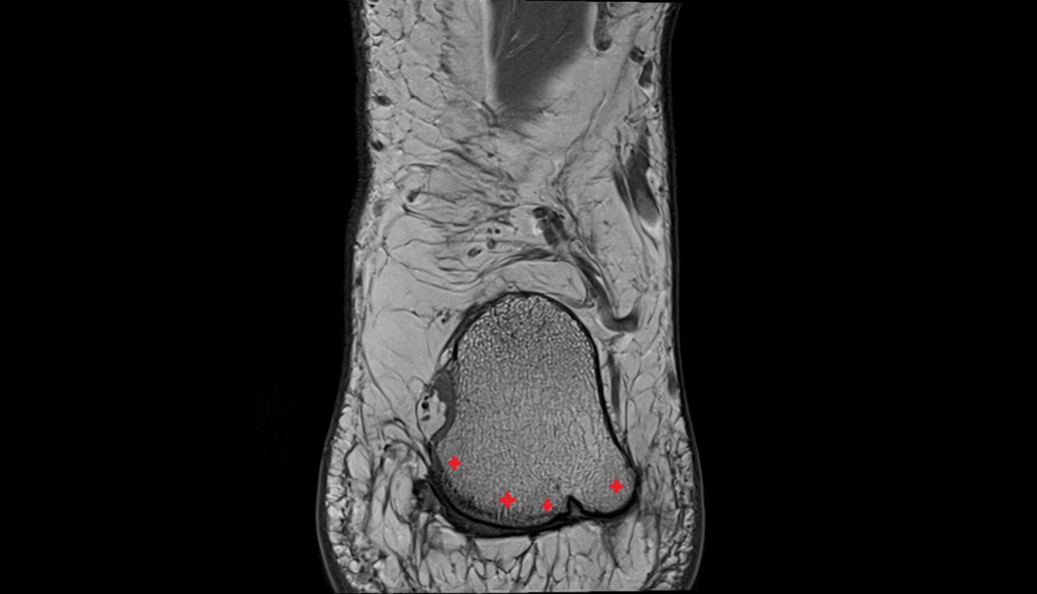 Calcaneal tuberosity  mri  anatomy labelled image-img-00000-00000_00001