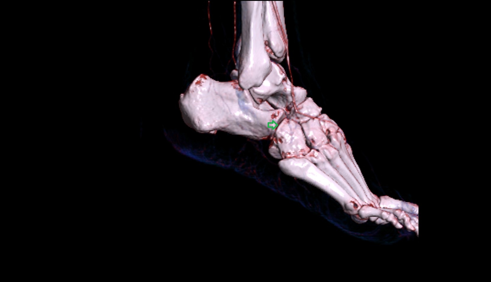 Calcaneocuboid joint 3d