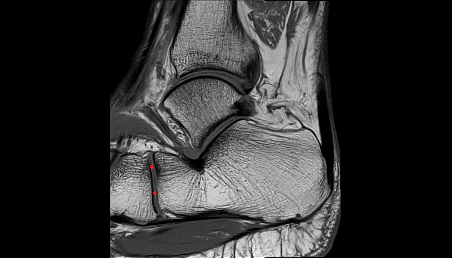 Calcaneocuboid joint   MRI sagittal  cross sectional anatomy 3T MRI AI enhanced radiology image-img-00000-00000