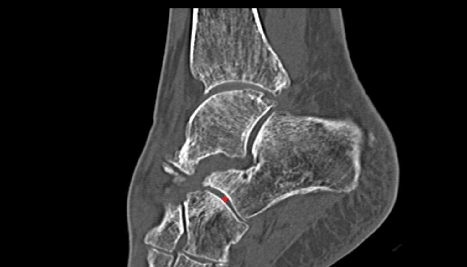 Calcaneocuboid joint sagittal  CT cross sectional anatomy radiology image-img-00000-00000