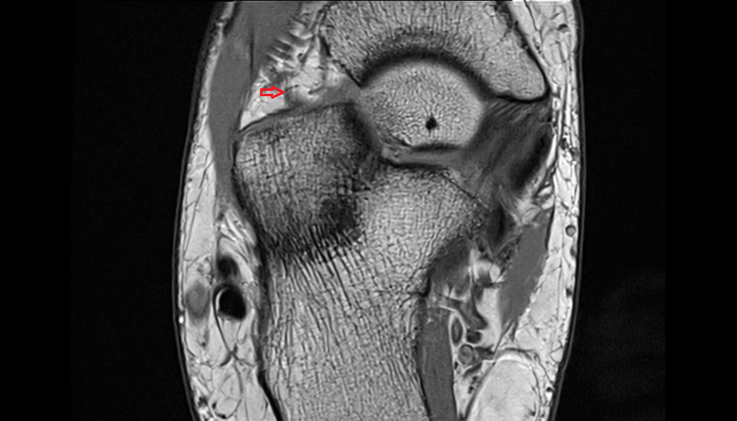 Calcaneocuboid ligament (Bifurcate ligament)  axial cross sectional anatomy 3T MRI AI enhanced radiology image-img-00000-00000