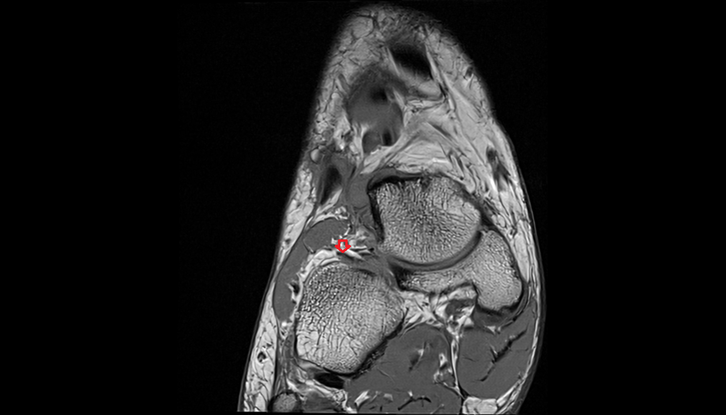 Calcaneocuboid ligament (Bifurcate ligament)  coronal cross sectional anatomy 3T MRI AI enhanced radiology image-img-00000-00000
