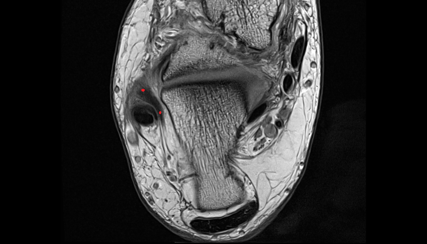 Calcaneofibular ligament axial cross sectional anatomy 3T MRI AI enhanced radiology image-img-00000-00000