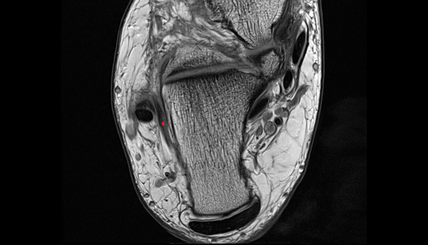 Calcaneofibular ligament axial cross sectional anatomy 3T MRI AI enhanced radiology image-img-00000-00000_00001