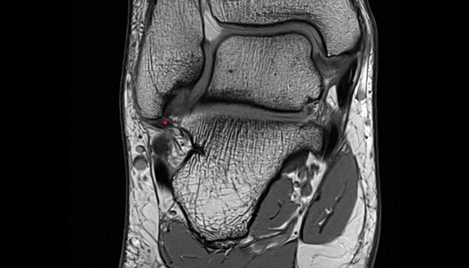 Calcaneofibular ligament  coronal cross sectional anatomy 3T MRI AI enhanced radiology image-img-00000-00000
