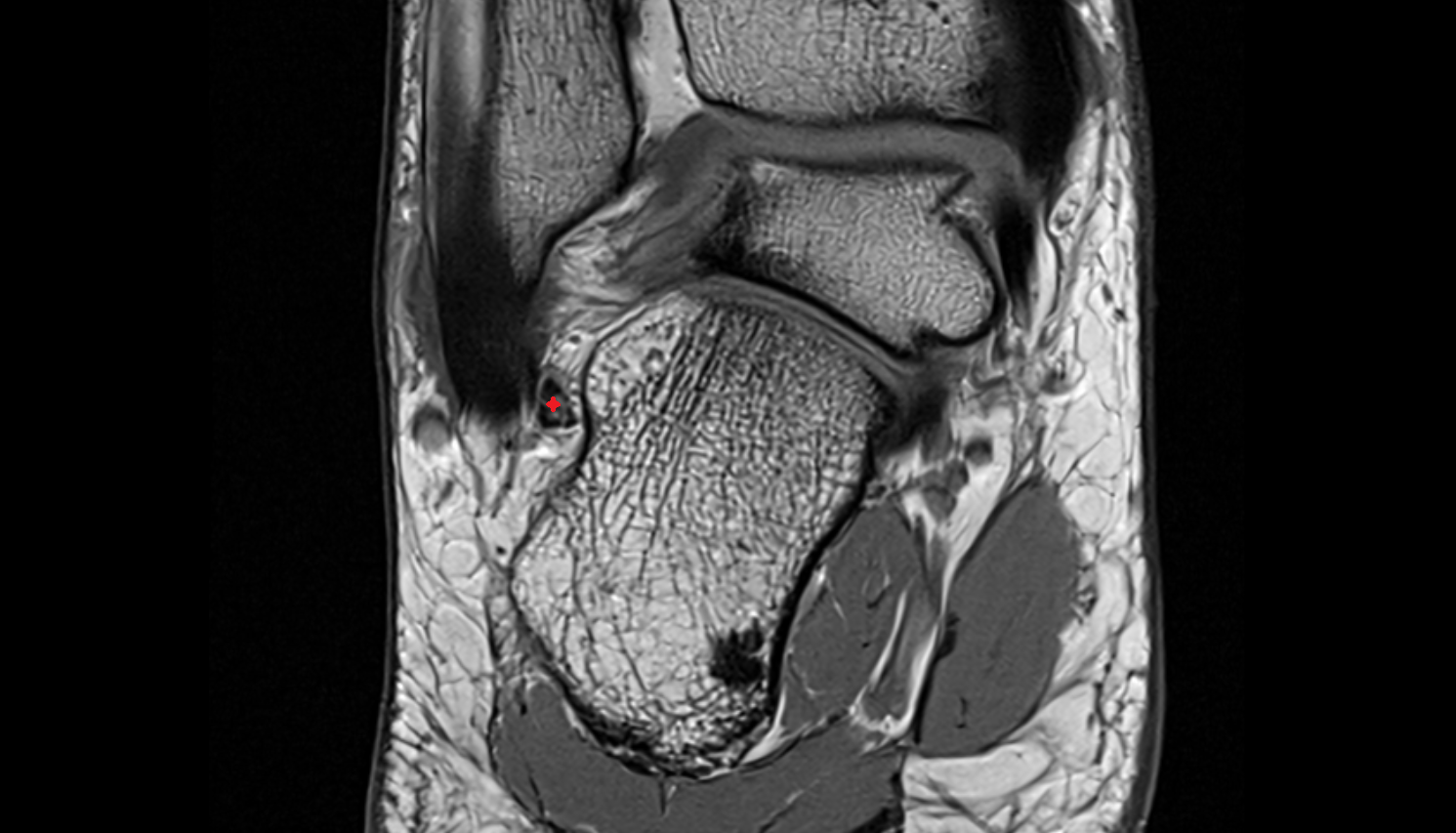 Calcaneofibular ligament  coronal cross sectional anatomy 3T MRI AI enhanced radiology image-img-00000-00000_00001