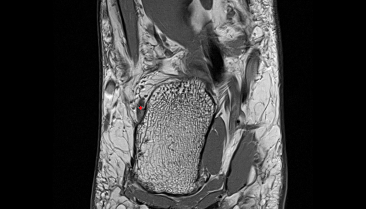 Calcaneofibular ligament  coronal cross sectional anatomy 3T MRI AI enhanced radiology image-img-00000-00000_00002