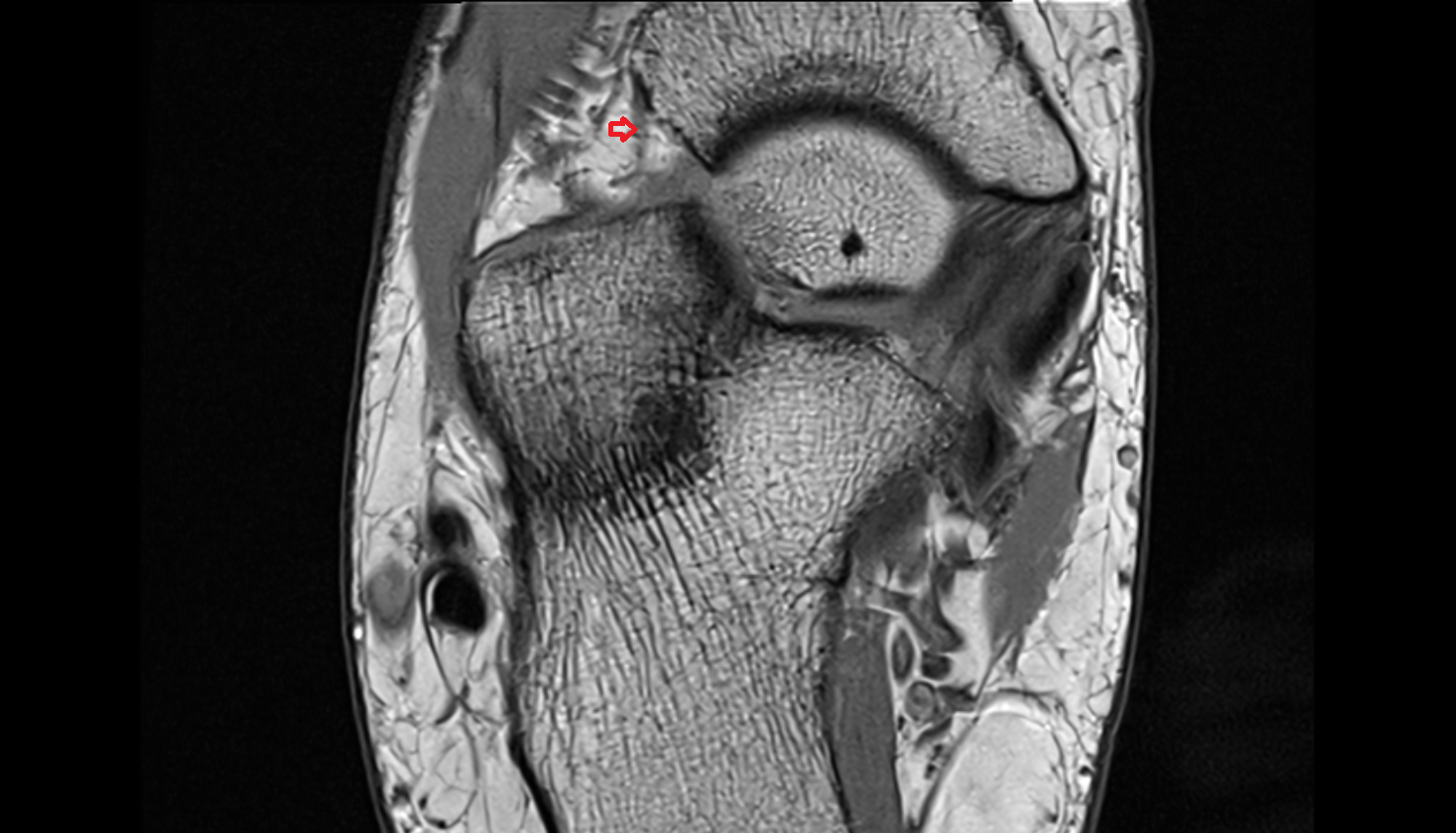 Calcaneonavicular ligament (Bifurcate ligament)  axial cross sectional anatomy 3T MRI AI enhanced radiology image-img-00000-00000