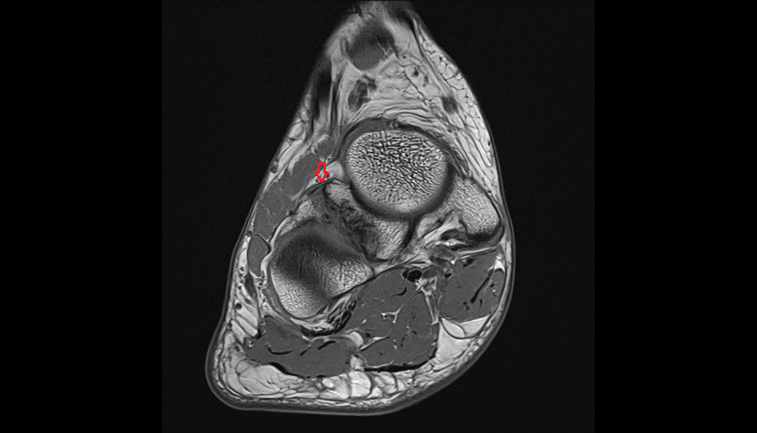 Calcaneonavicular ligament (Bifurcate ligament)  coronal cross sectional anatomy 3T MRI AI enhanced radiology image-img-00000-00000