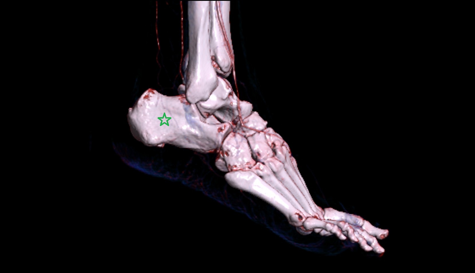 Calcaneus bone 3d image ct