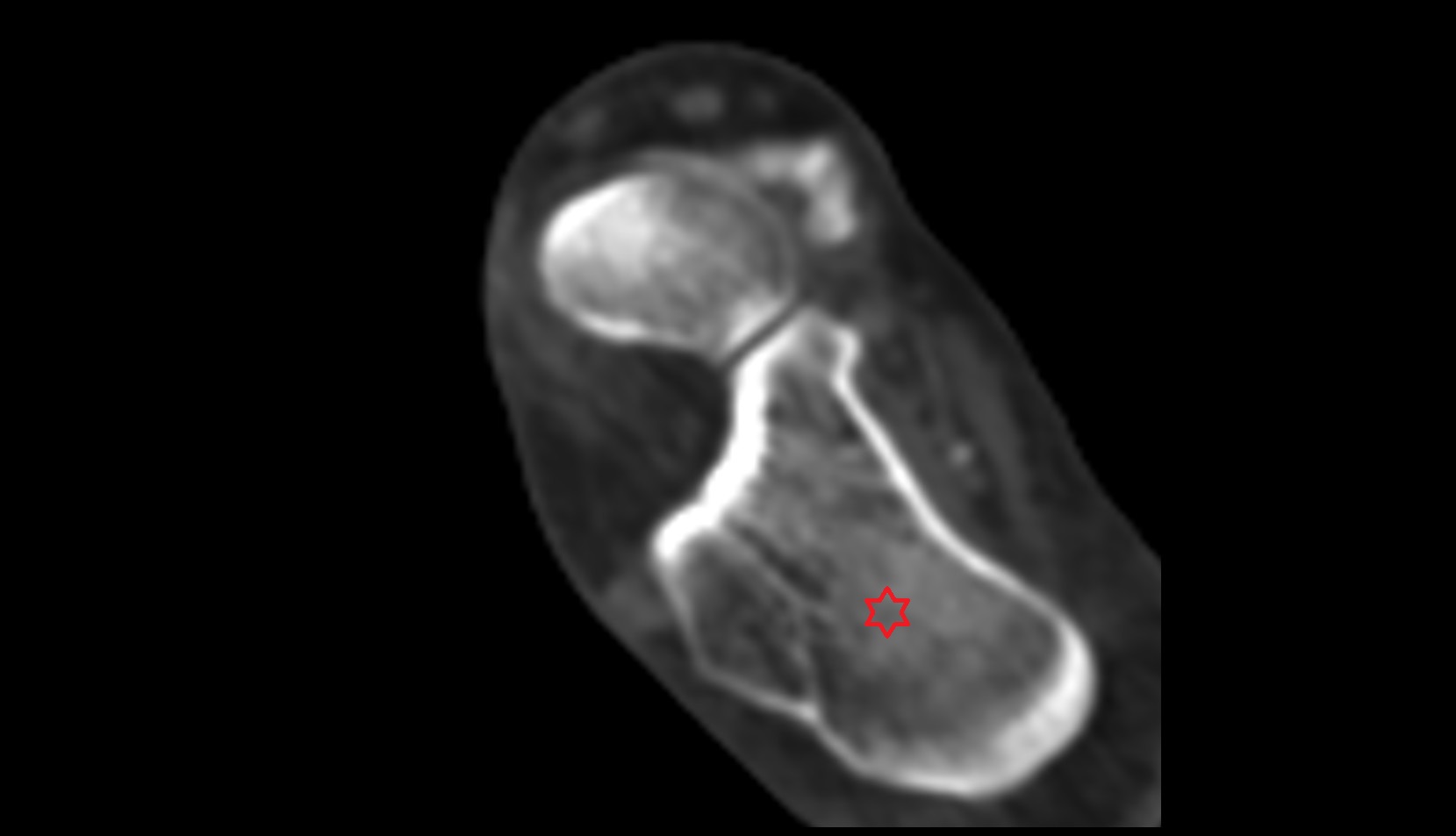 Calcaneus ct axial
