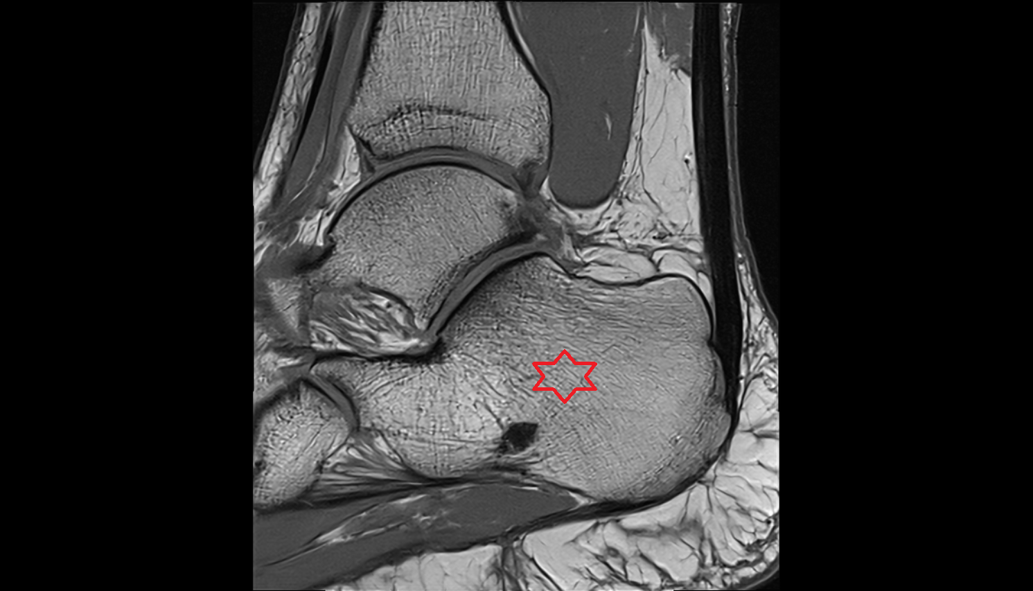 Calcaneus sagittal MRI cross sectional anatomy 3T MRI AI enhanced radiology image-img-00000-00000