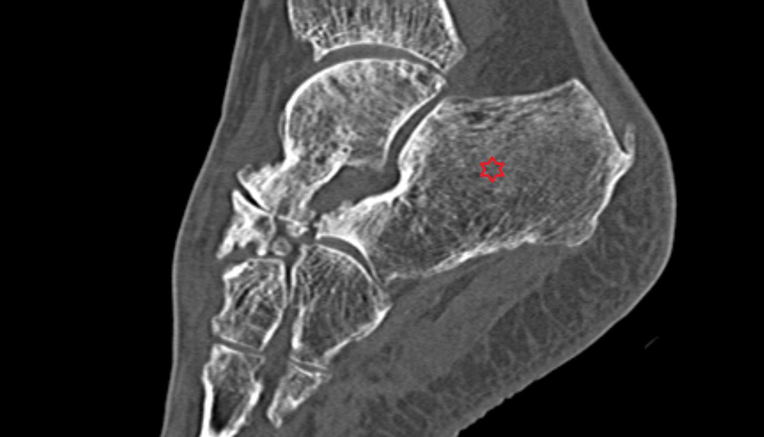 Calcaneus sagittal ct cross sectional anatomy  AI enhanced radiology image-img-00000-00000