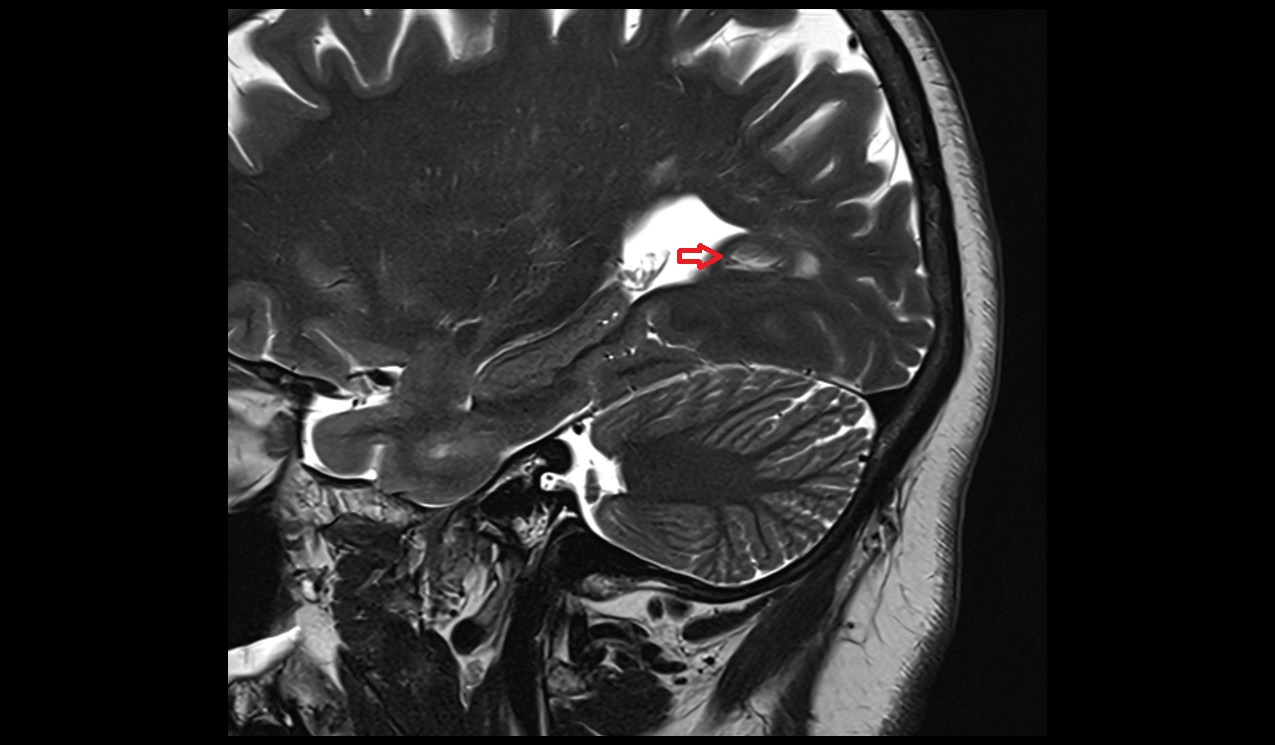 Calcarine spur mri 3t sagittal image