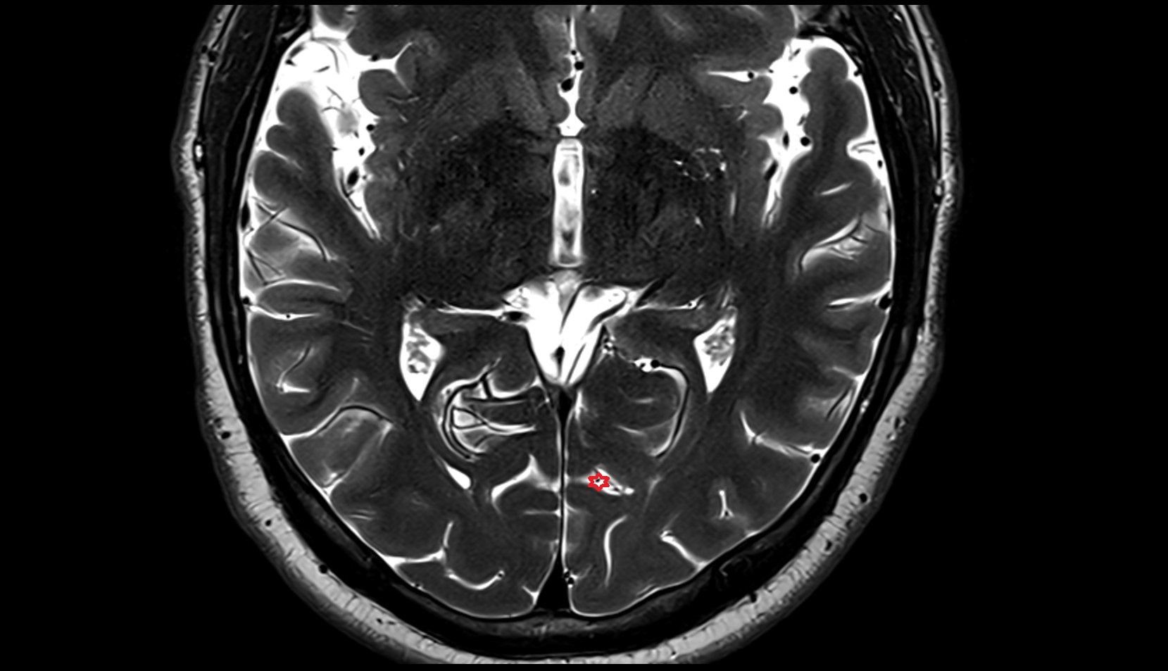 Calcarine sulcus MRI 3T axial image