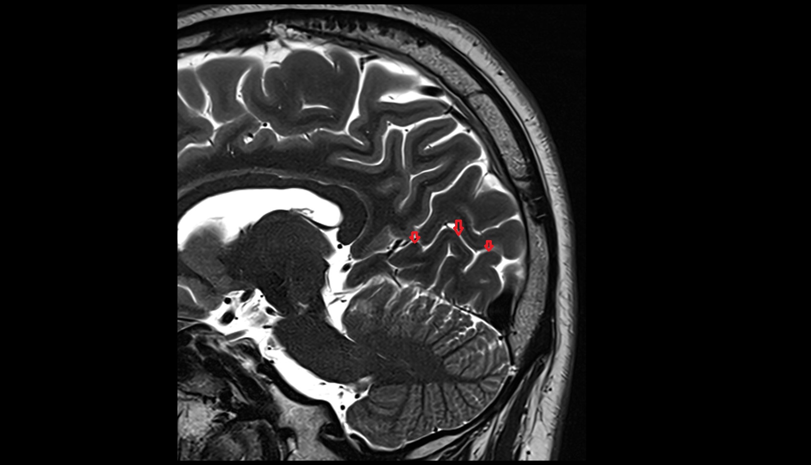 Calcarine sulcus MRI 3T sagittal  image