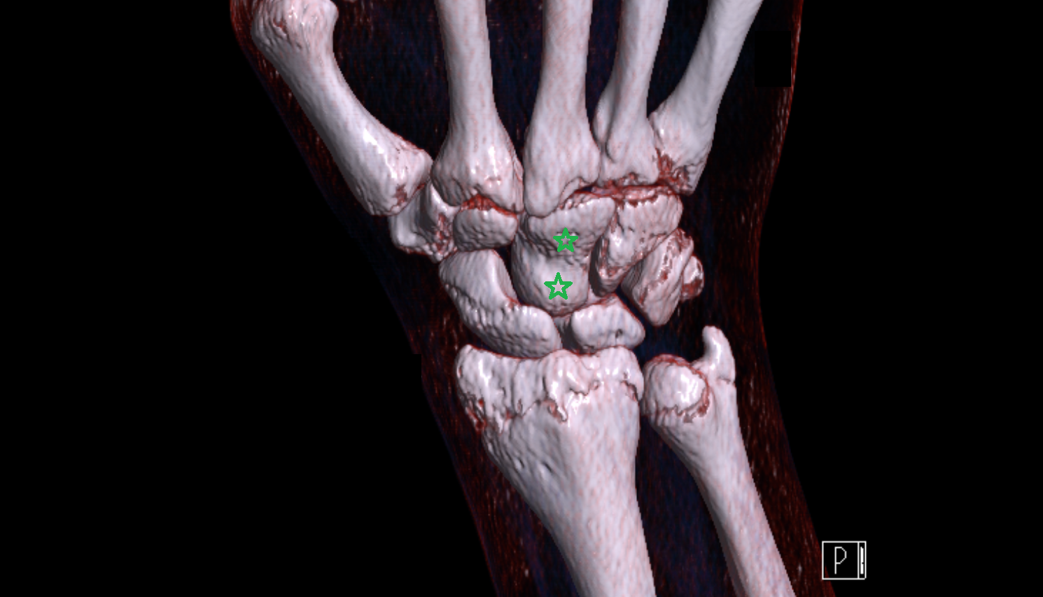 Capitate bone CT 3D VRT image -img-00000-00000