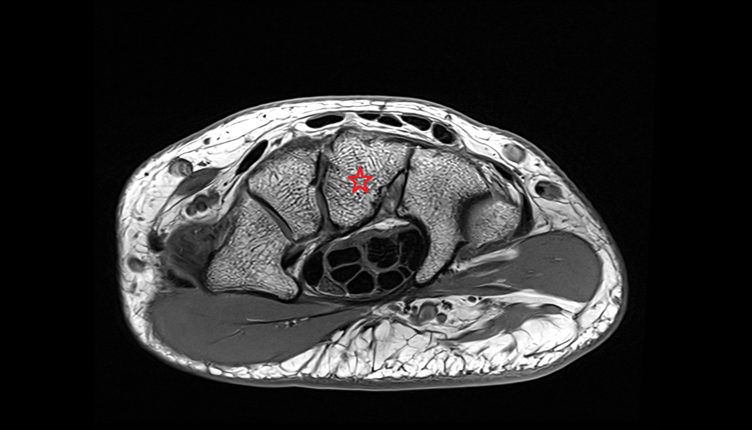 Capitate bone  bone axial cross sectional anatomy 3T MRI AI enhanced radiology image-img-00000-00000