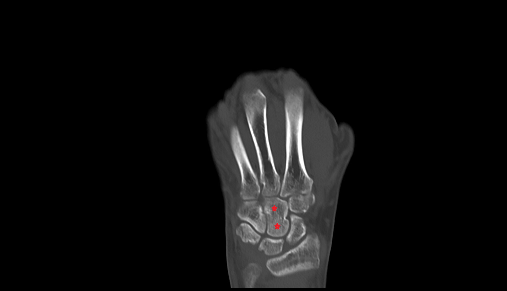 Capitate bone coronal image ct