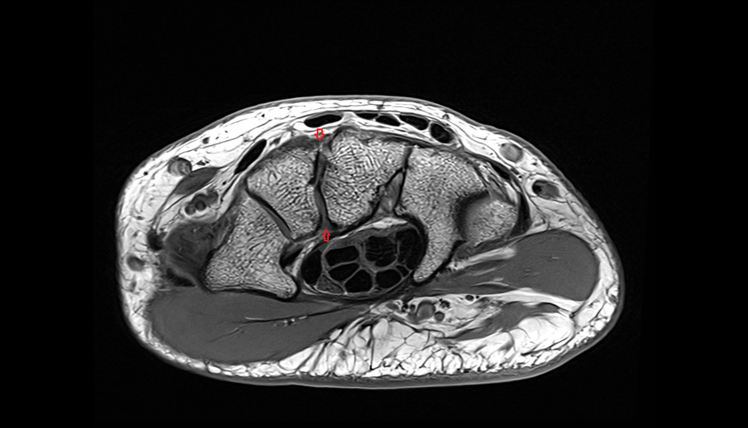 Capitotrapezoid (Trapezocapitate) Ligament  mri axial cross sectional anatomy 3T MRI AI enhanced radiology image-img-00000-00000_00001