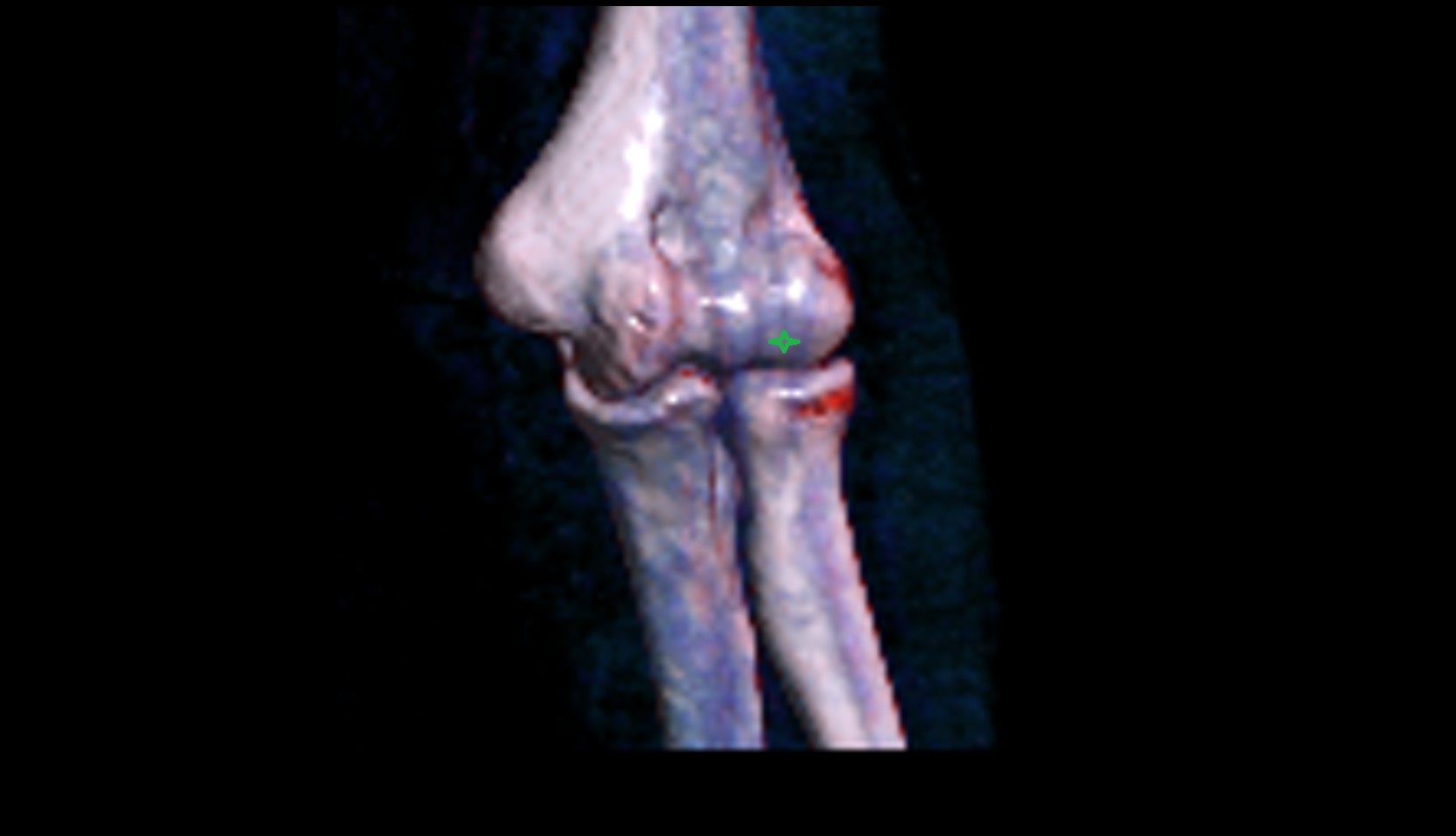 Capitulum of humerus CT 3D VRT IMAGE