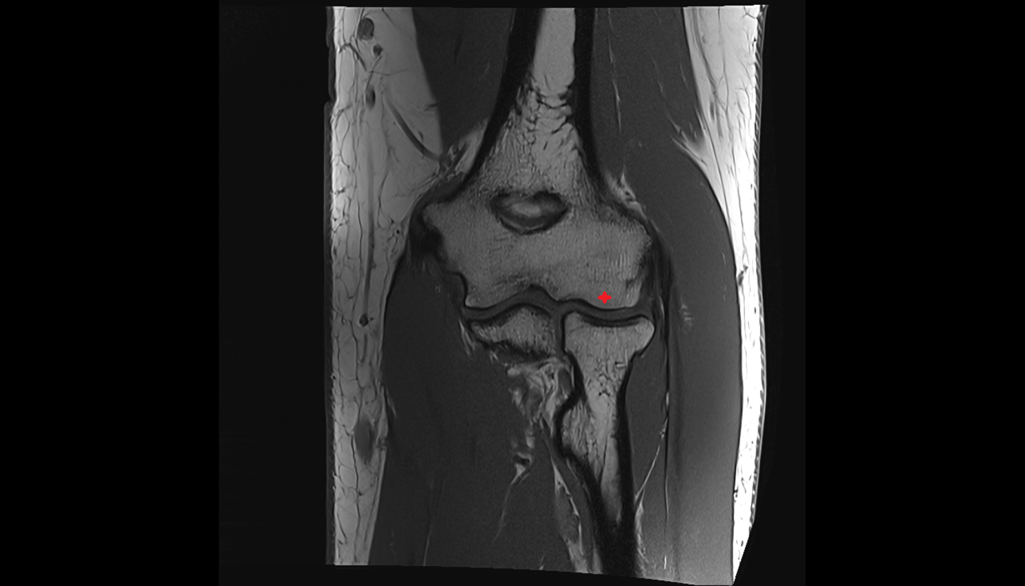 Capitulum of humerus coronal cross sectional anatomy 3T MRI AI enhanced radiology image -img-00000-00000