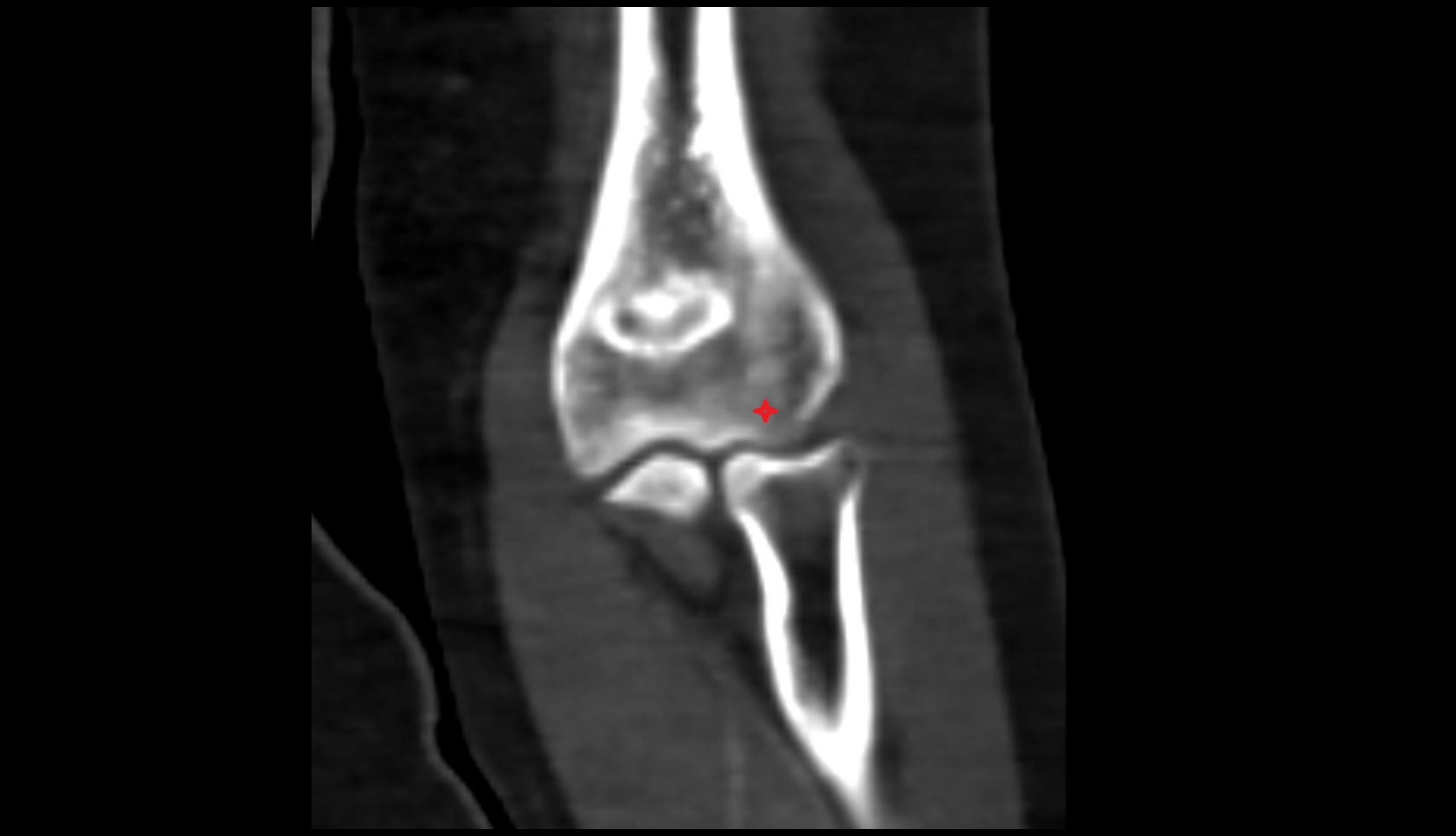 Capitulum of humerus ct coronal image