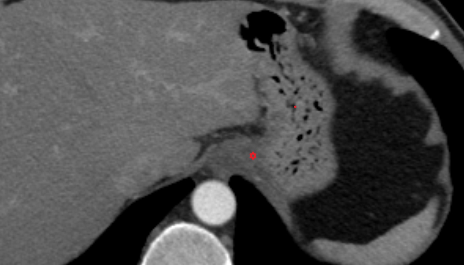 Cardia  of stomach  anatomy  CT  axial  image -img-00000-00000