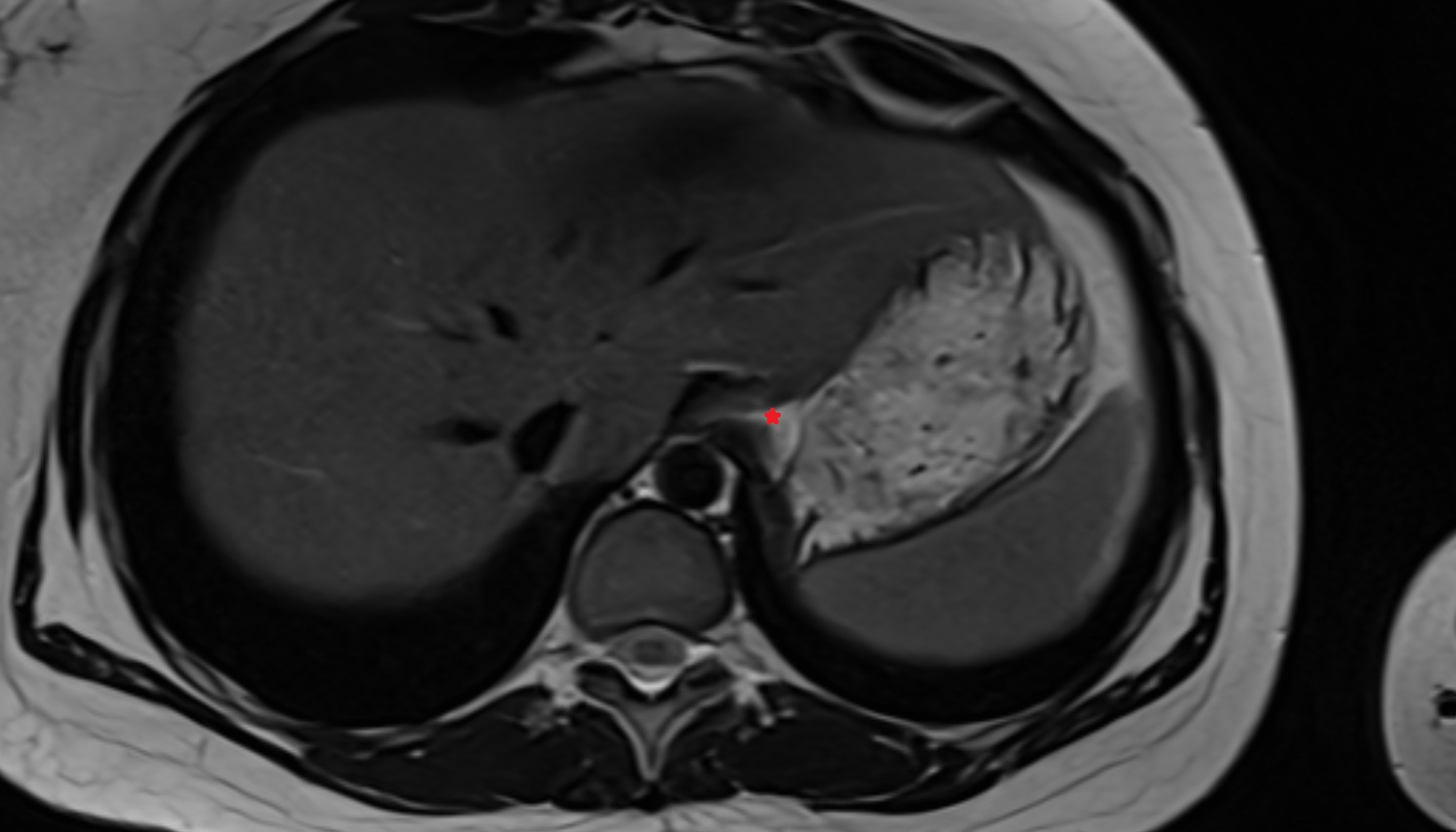 Cardia  of stomach  anatomy  MRI  axial  image -img-00000-00000