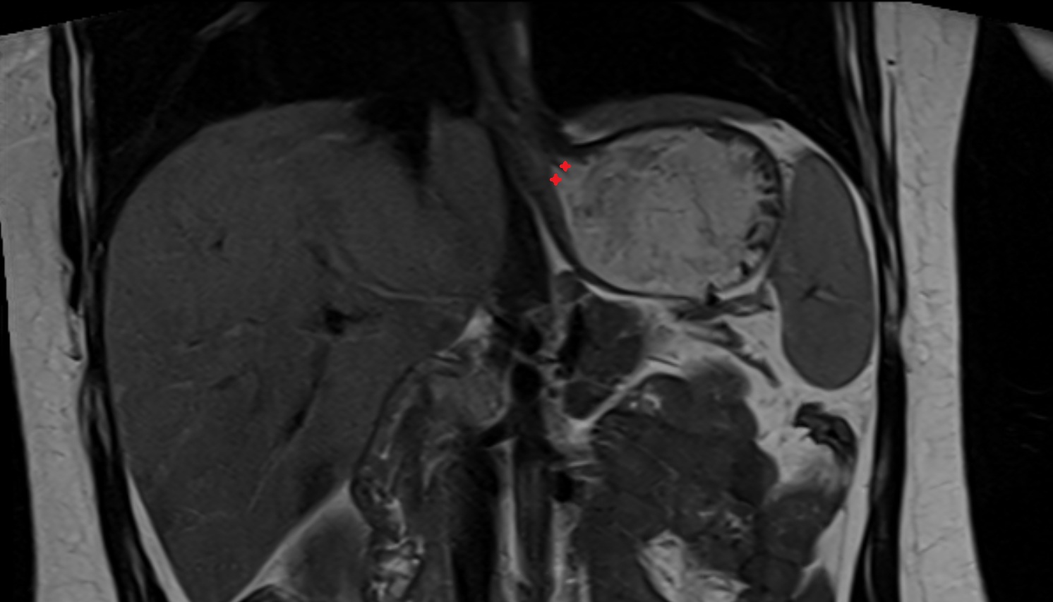 Cardia  of stomach  anatomy  MRI  coronal  image -img-00000-00000