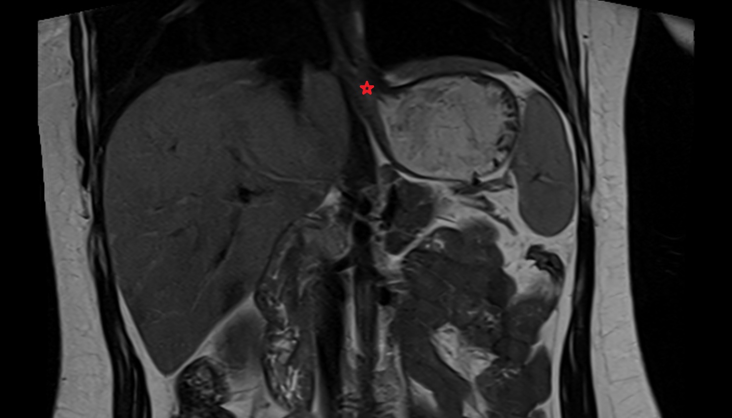 Cardia (stomach) anatomy   MRI coronal  anatomy  image -img-00000-00000