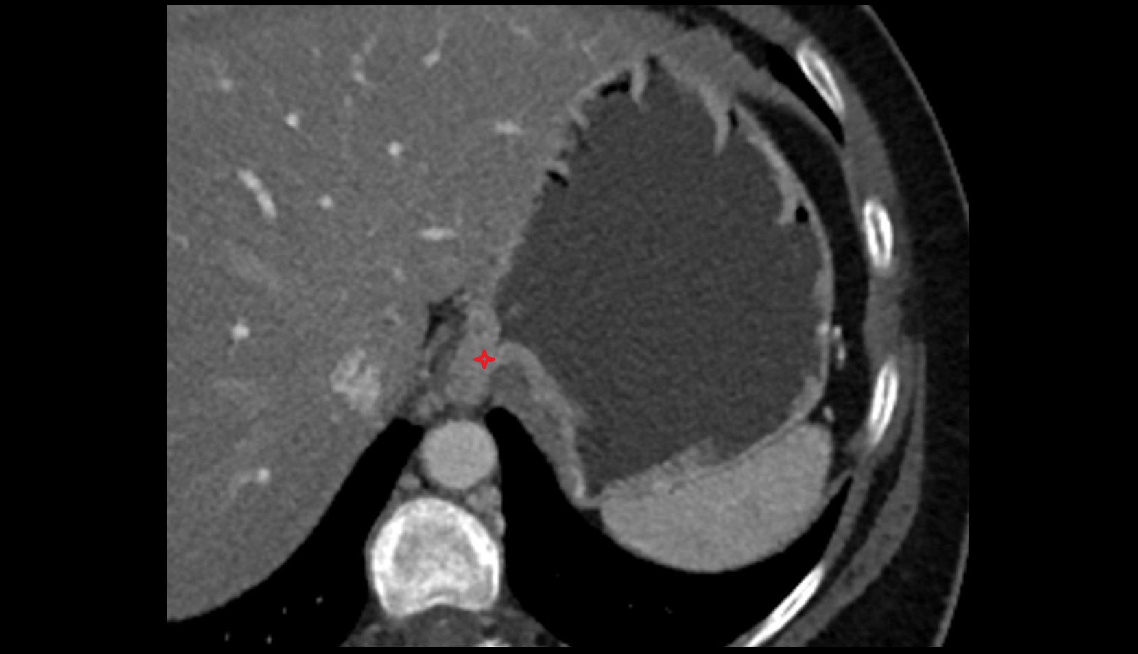 Cardia (stomach) anatomy ct axial  image