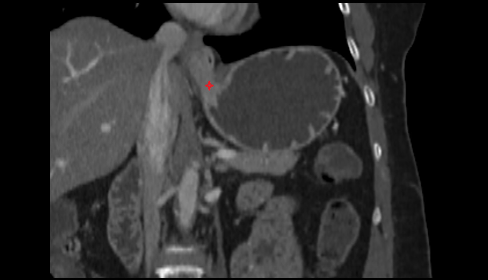 Cardia (stomach) anatomy ct coronal image