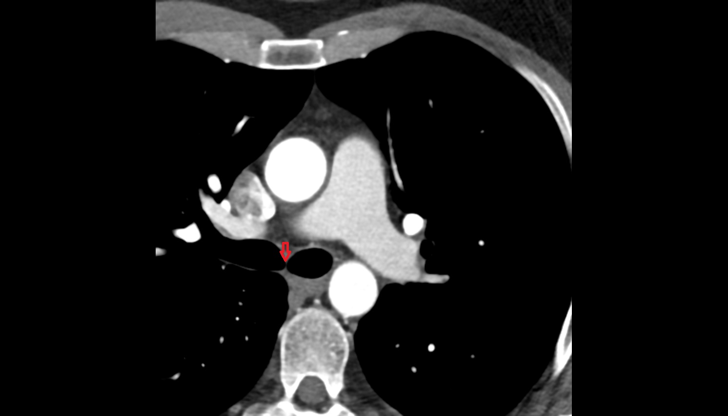 Carina of trachea  anatomy CT axial  image -img-00000-00000