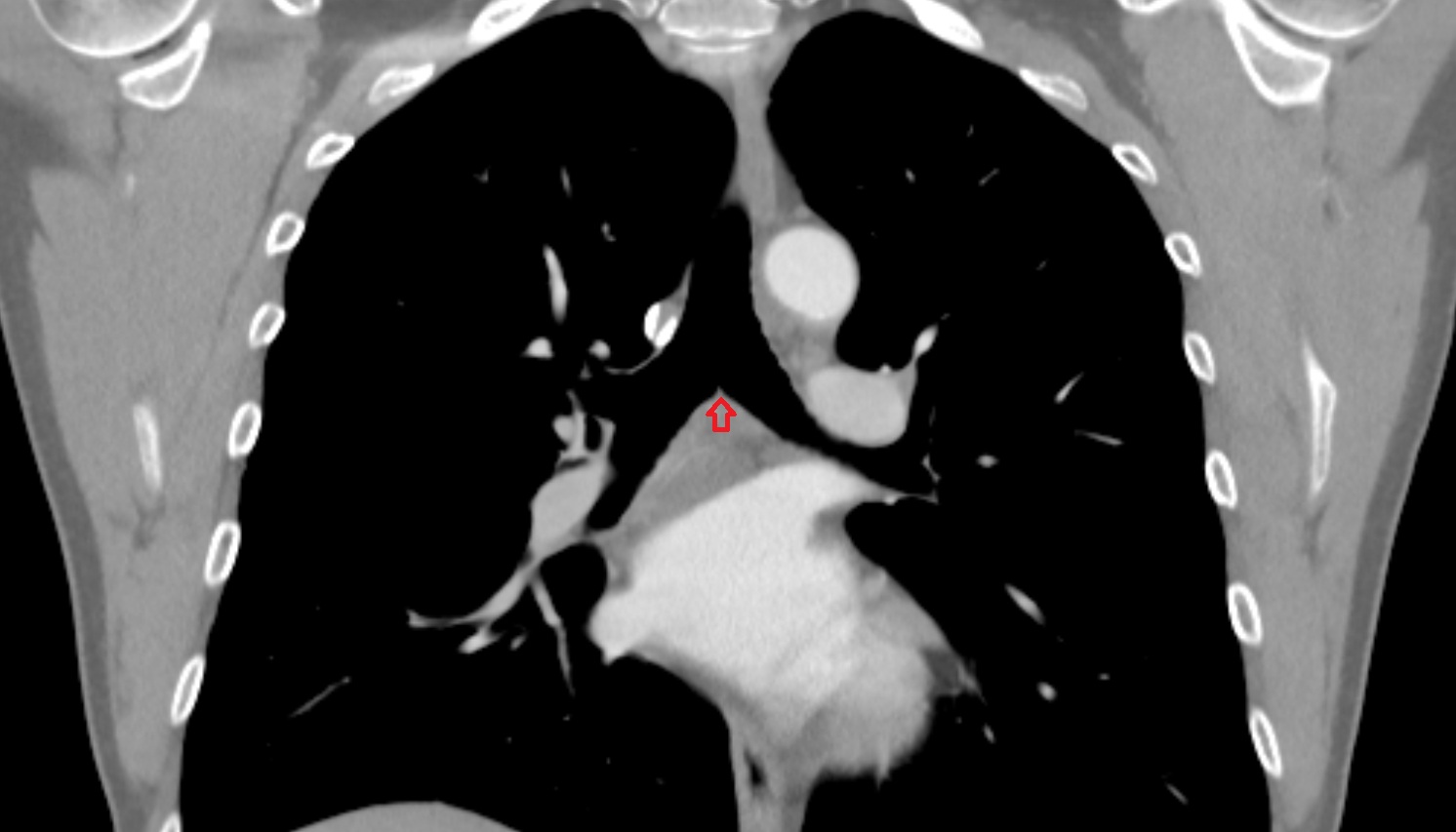 Carina of trachea  anatomy CT coronal  image -img-00000-00000