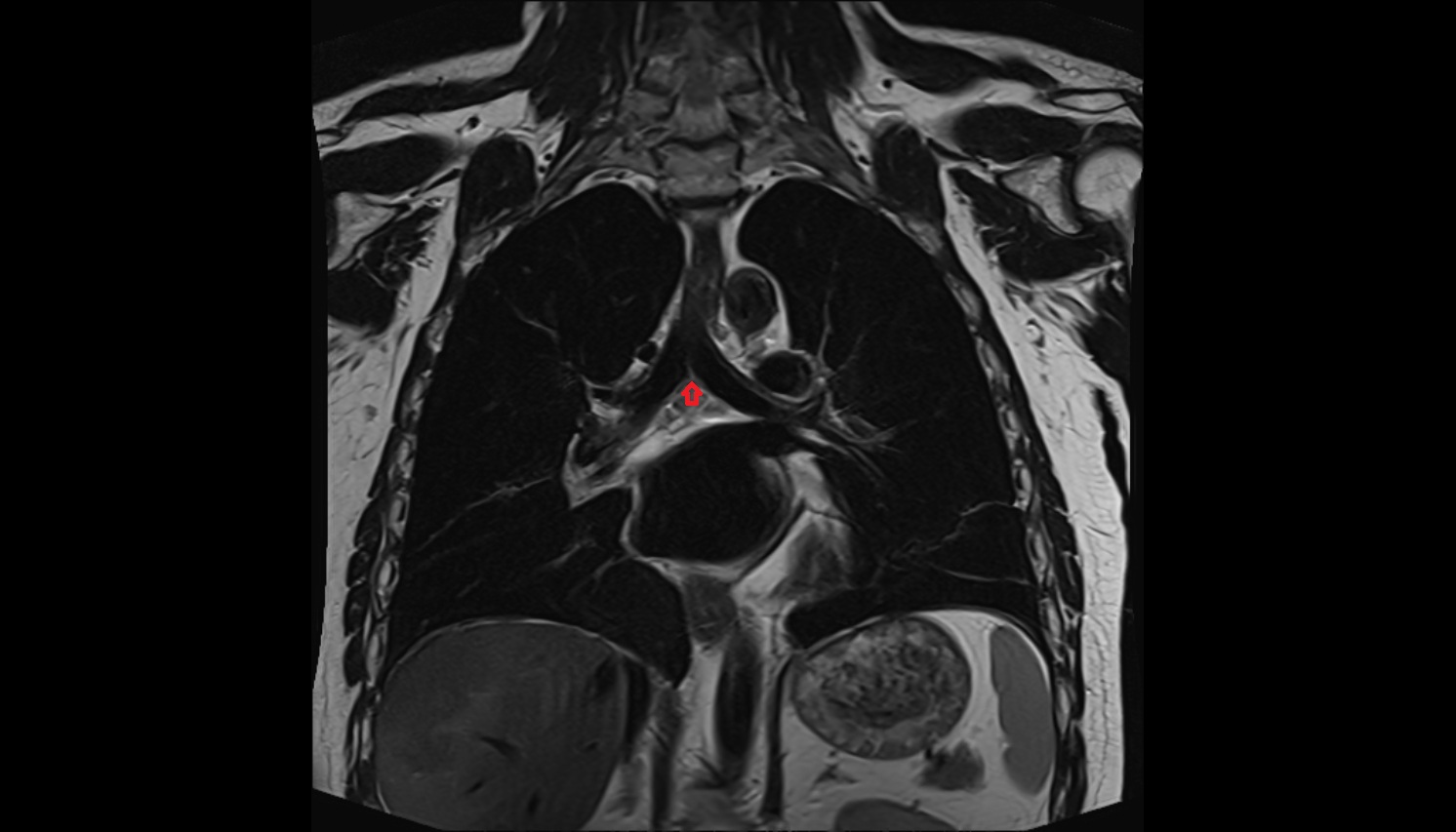 Carina of trachea  anatomy MRI coronal  image -img-00000-00000