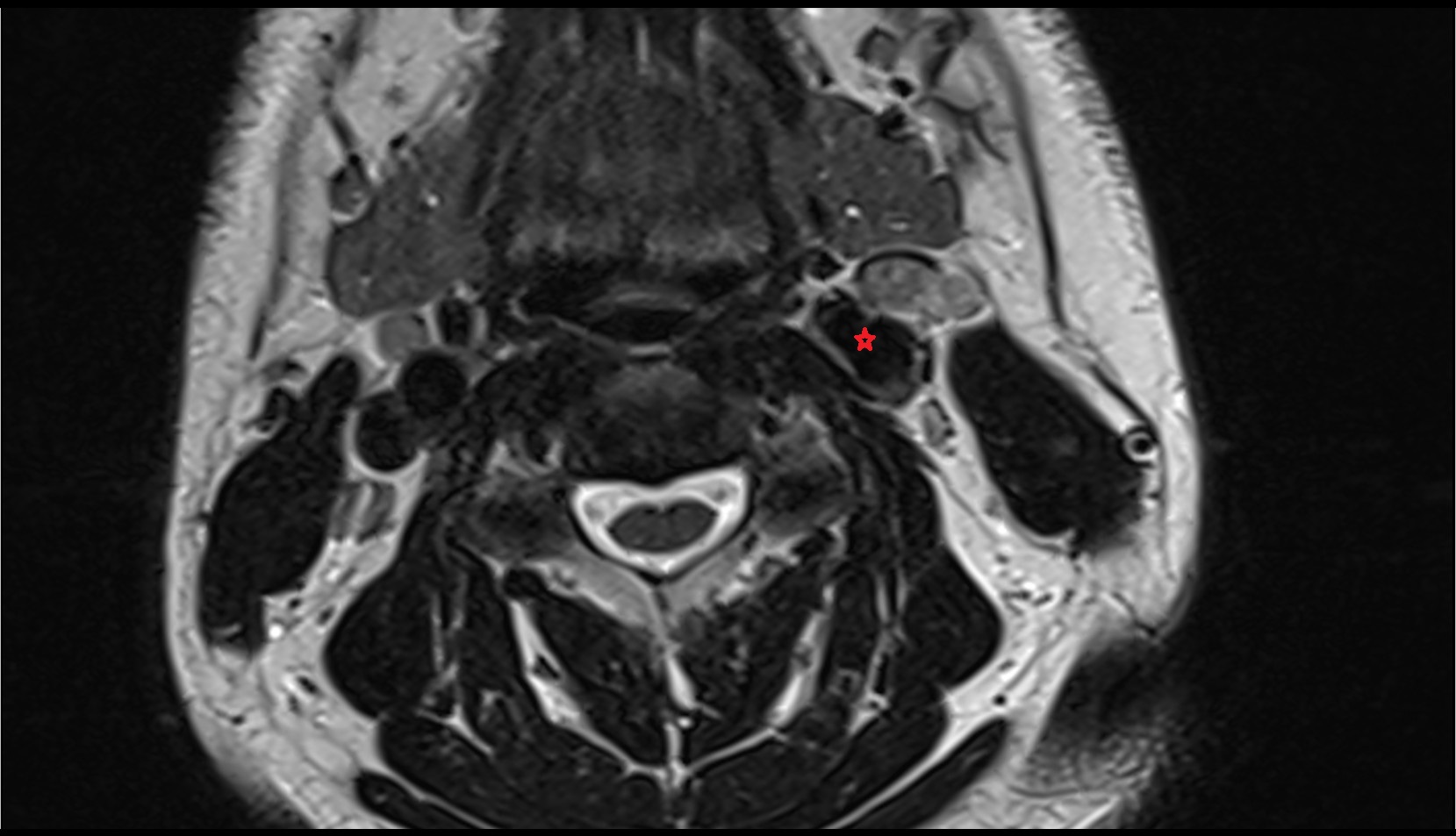 Carotid bifurcation axial t2