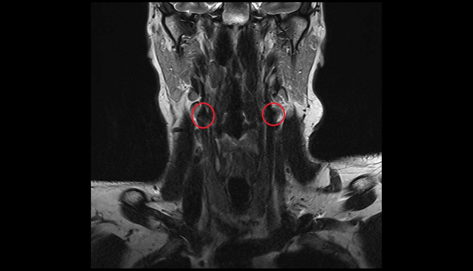 Carotid bifurcation coronal mri image