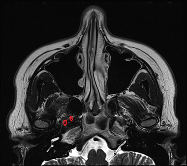 Carotid canal mri axial image -img-00000-00000