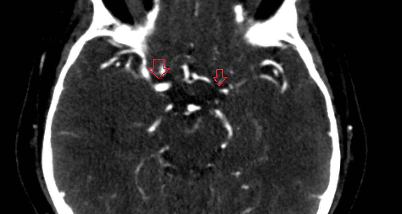 Carotid cistern  CT axial anatomy image -img-00001-00001