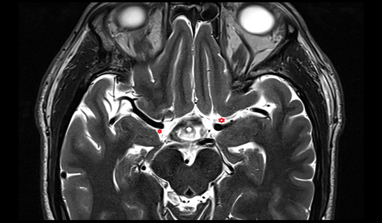 Carotid cistern axial mri 3t image