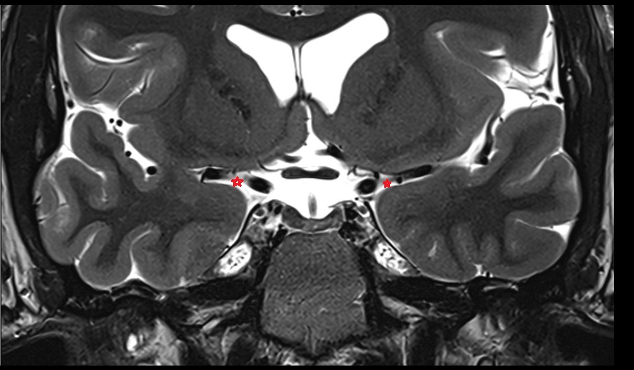 Carotid cistern coronal mri 3t image