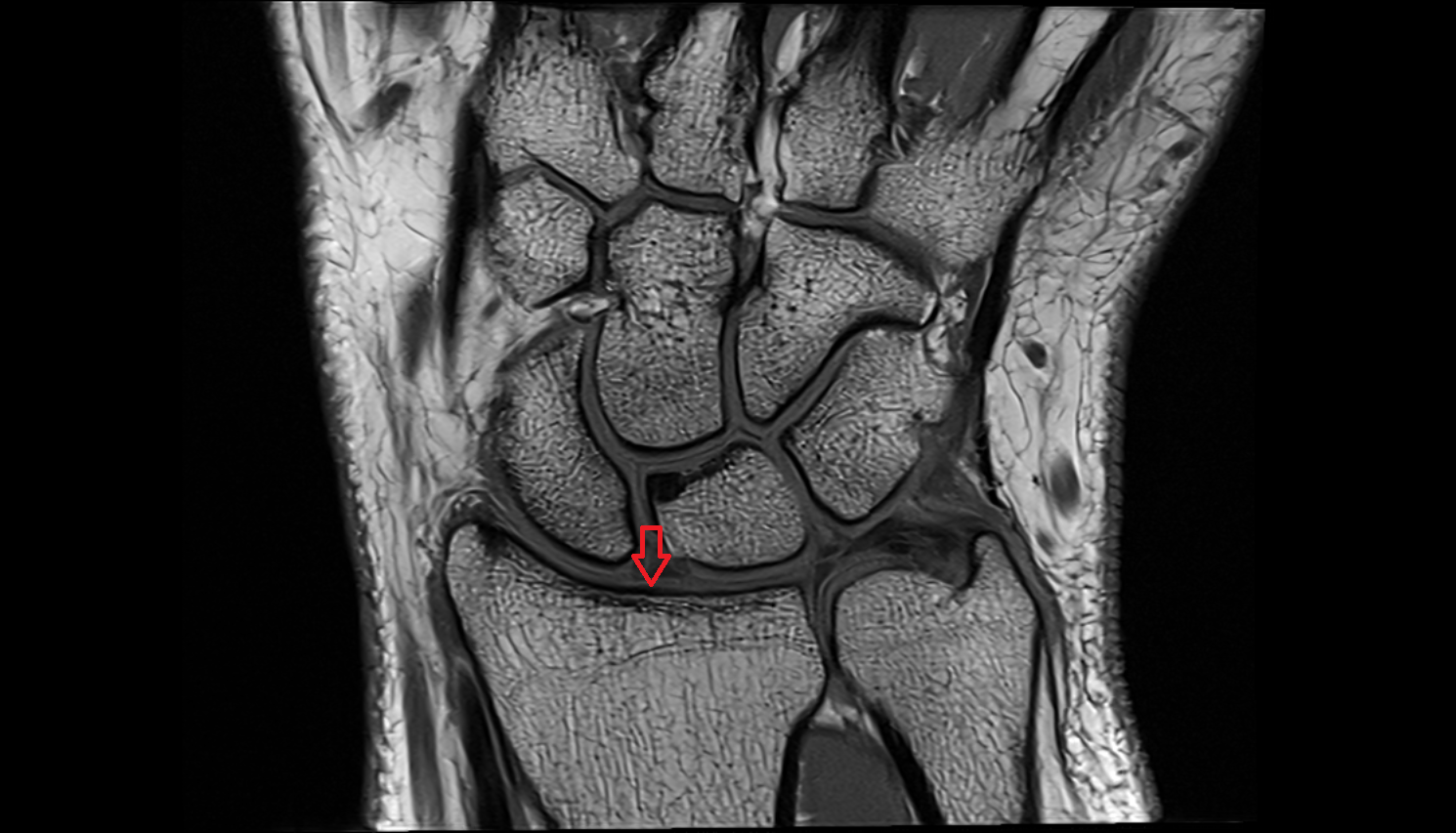 Carpal articular surface   coronal cross sectional anatomy 3T MRI AI enhanced radiology image-img-00000-00000