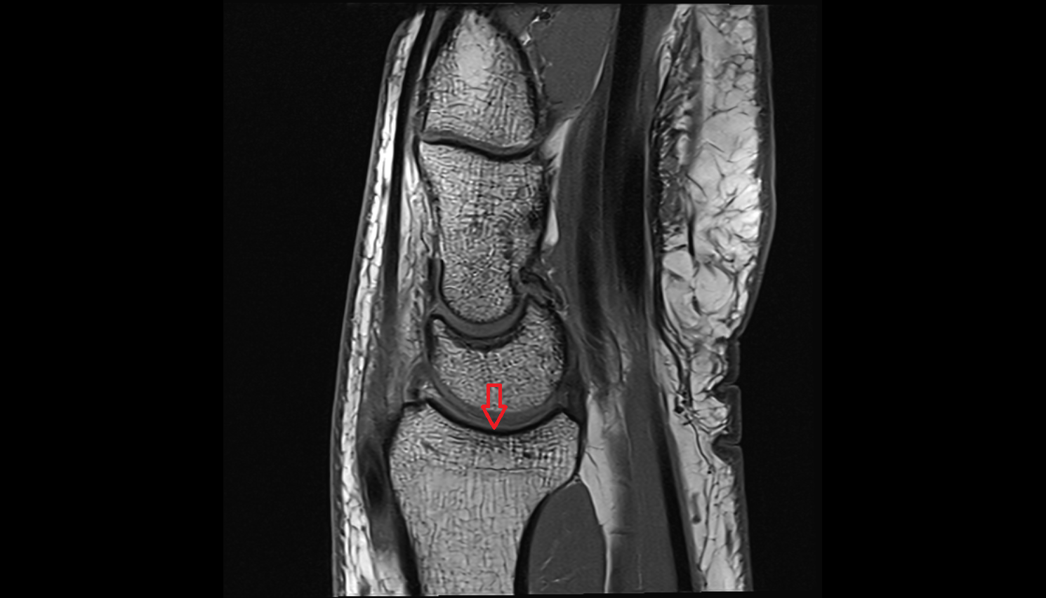 Carpal articular surface sag cross sectional anatomy 3T MRI AI enhanced radiology image-img-00000-00000