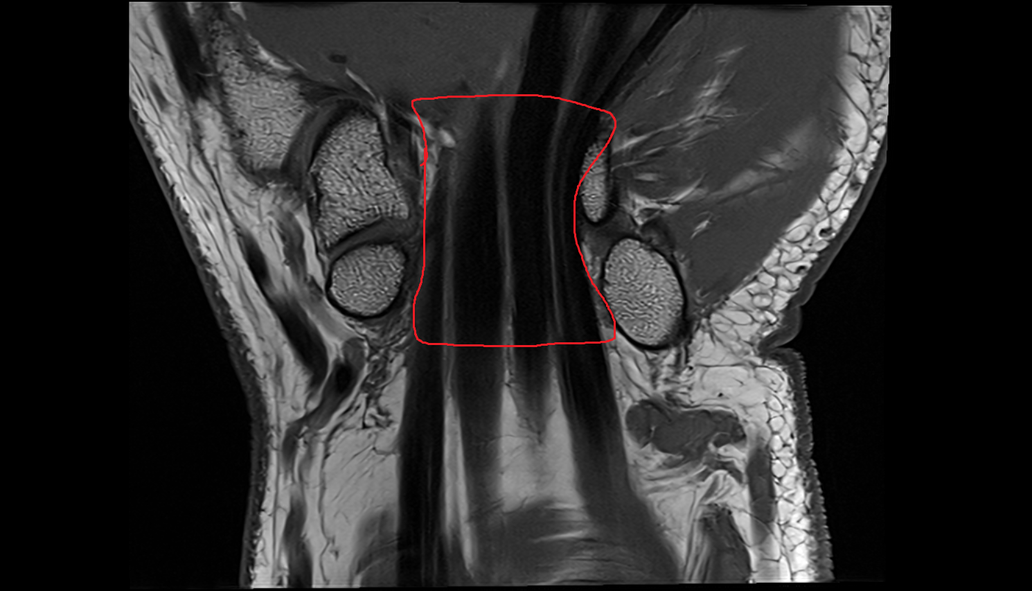 Carpal tunnel region coronal cross sectional anatomy 3T MRI AI enhanced radiology image-img-00000-00000