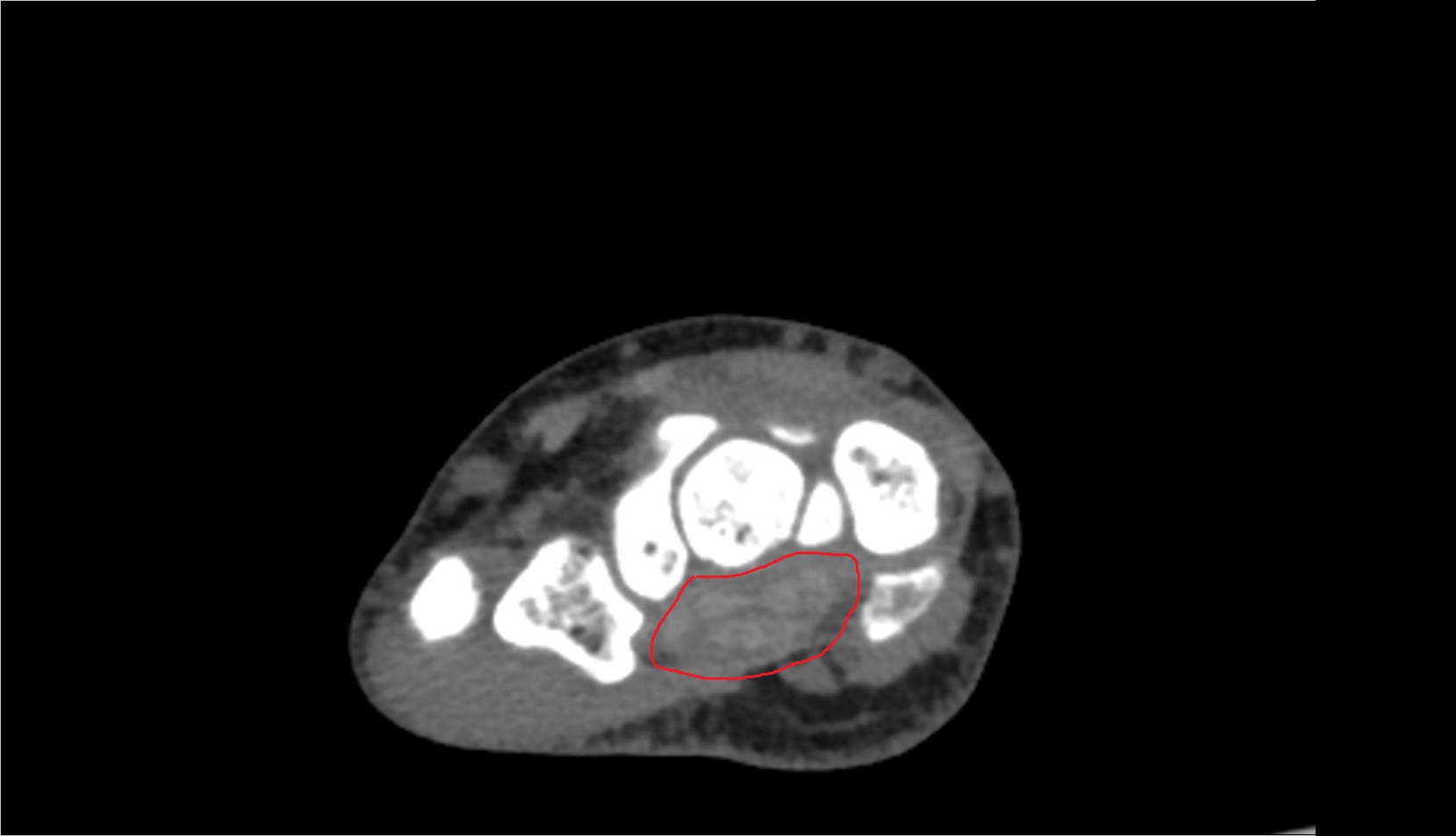 Carpal tunnel region ct axial